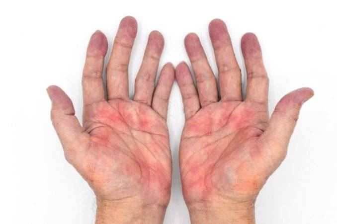 Долгото црвенило на дланките може да е знак за замастен црн дроб