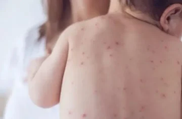 Епидемија на мали сипаници избувна во северен Лондон каде повеќе од 60 деца се заразени, објавија здравствените власти, повикувајќи за вакцинација на деца, јавија денеска британските медиуми.