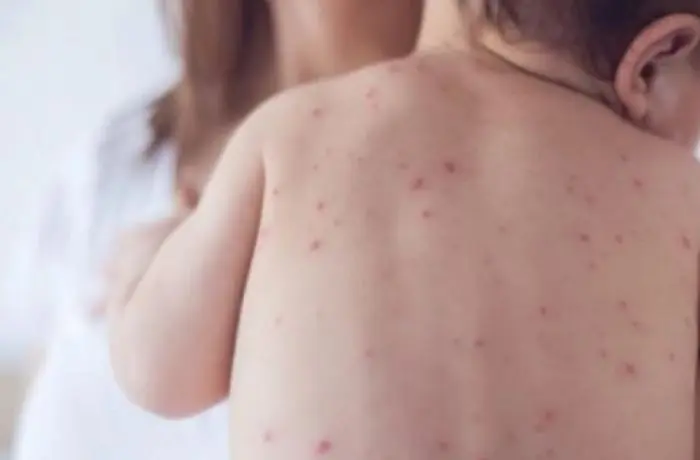 ЕПИДЕМИЈА НА МАЛИ СИПАНИЦИ ВО ЛОНДОН: Се шират предупредувања за итна вакцинација